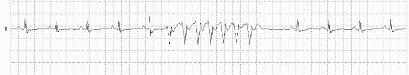 Non-sustained Ventricular Tachycardia Rhythm Strip